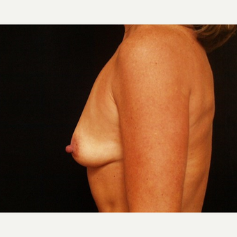35-44 year old woman treated with Breast Augmentation before 3576328