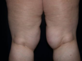 Liposuction before 581687