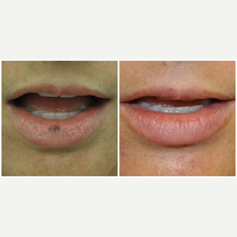 25-34 year old woman treated with Laser Treatment before 3590607