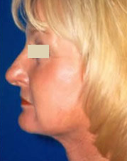 Facelift after 97297