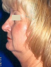 Facelift before 97297