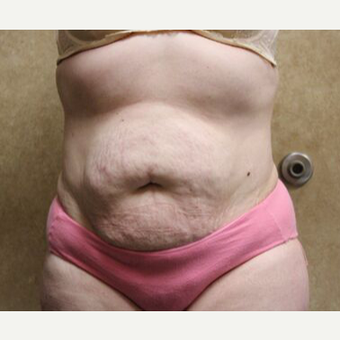 Tummy Tuck with Liposuction before 3454656