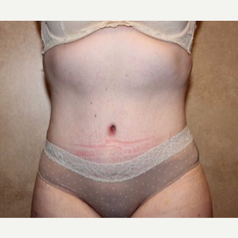 Tummy Tuck with Liposuction after 3454656