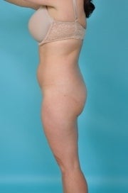 41 yo Female Liposuction of Abdomen, Flanks, and Medial Thighs, 6 Months Post Procedure 1441971