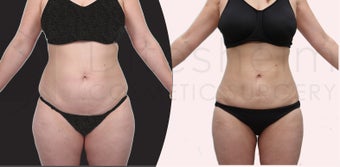 Water liposuciton, aquashape, body-jet liposuction. Liposuction after two children before 1113804