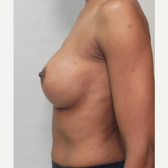 Breast Implants after 3241609
