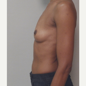 Breast Implants before 3241609
