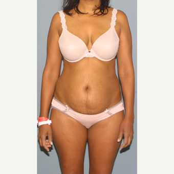 45-54 year old woman treated with Tummy Tuck before 3559282