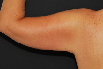 Brachioplasty after 949034