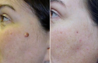 Mole Removal before 1211993