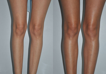 Calf Implants before 1111931
