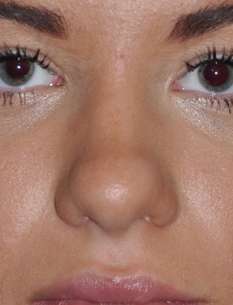 19 Year Old Female Treated For A Fat Nose before 964939