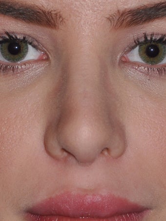 19 Year Old Female Treated For A Fat Nose after 964939