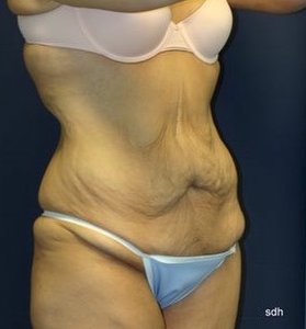 18-24 year old woman treated with Body Lift before 1679442