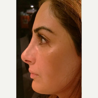 25-34 year old woman treated with Rhinoplasty after 3687097