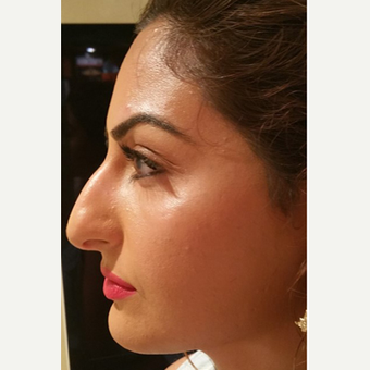 25-34 year old woman treated with Rhinoplasty before 3687097