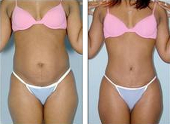 Tummy Tuck (Abdominoplasty) before 324854