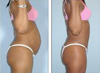 Tummy Tuck (Abdominoplasty) 324854