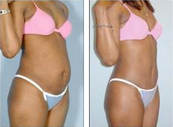 Tummy Tuck (Abdominoplasty) after 324854