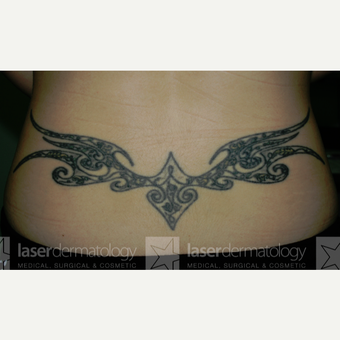 25-34 year old woman treated with Tattoo Removal before 1830488