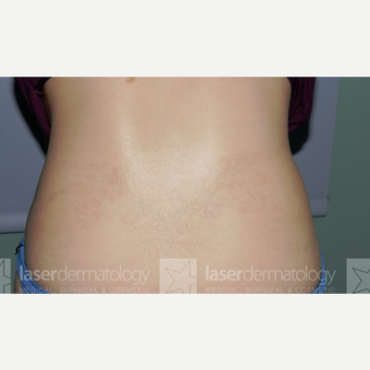 25-34 year old woman treated with Tattoo Removal after 1830488