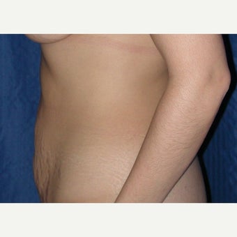 35-44 year old woman treated with Tummy Tuck 1961718
