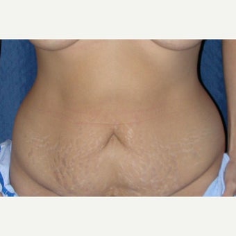 35-44 year old woman treated with Tummy Tuck before 1961718
