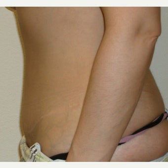 35-44 year old woman treated with Tummy Tuck 1961718