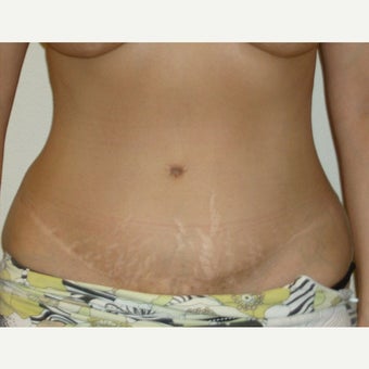 35-44 year old woman treated with Tummy Tuck after 1961718