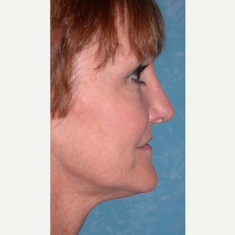 44 year old woman with Rhinoplasty after 3732563