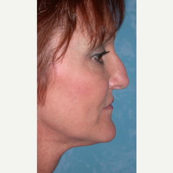 44 year old woman with Rhinoplasty before 3732563