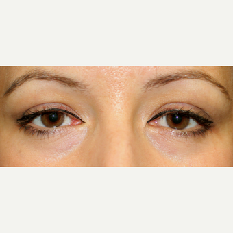 Transconjunctival blepharoplasty in young woman after 2767740