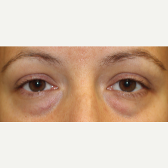 Transconjunctival blepharoplasty in young woman before 2767740