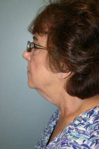 66 year old Female 934277