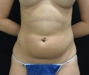 25-34 year old woman treated with Liposuction to Flanks / Love Handles before 3200828