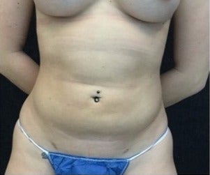 25-34 year old woman treated with Liposuction to Flanks / Love Handles after 3200828