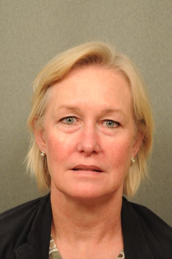 55 year old female with diffuse facial redness before 927792