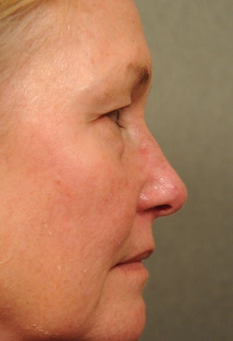55 year old female with diffuse facial redness 927792