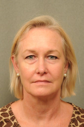 55 year old female with diffuse facial redness after 927792