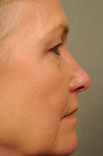 55 year old female with diffuse facial redness 927792