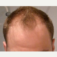 35 year old man treated with Hair Transplant before 3815584