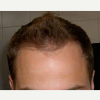 35 year old man treated with Hair Transplant after 3815584