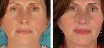 Revision Rhinoplasty before 1208280