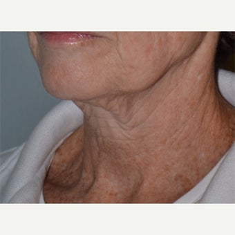 55-64 year old woman treated with Ultherapy 1859750
