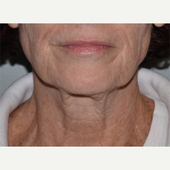55-64 year old woman treated with Ultherapy before 1859750