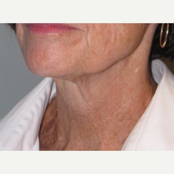 55-64 year old woman treated with Ultherapy 1859750