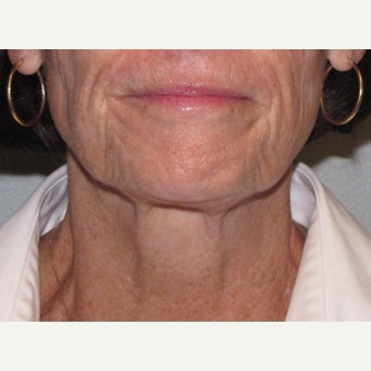 55-64 year old woman treated with Ultherapy after 1859750