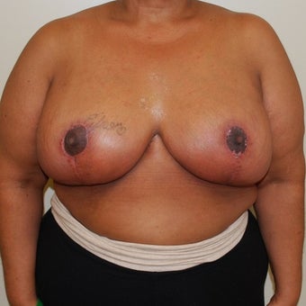 45-54 year old woman treated with Breast Reduction after 1650279
