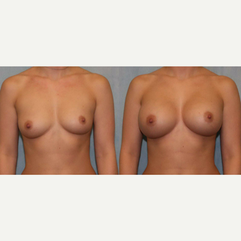 25-34 year old woman treated with Breast Augmentation before 3418410