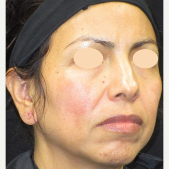 45-54 year old woman treated with Age Spots Treatment after 3152761